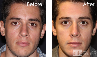 vivace for sun spots etc