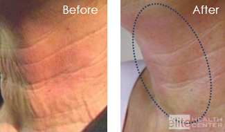 vivace prp microneedling for the neck