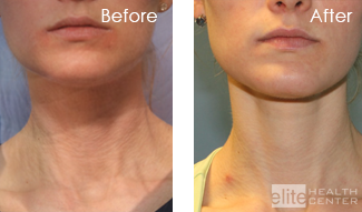 vivace rf microneedling neck